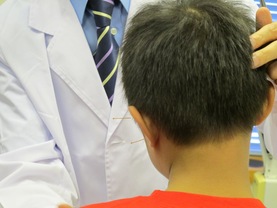 中医师示范为儿童自闭症患者施针。